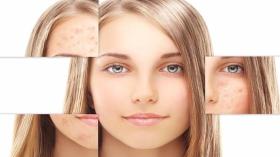 للقضاء على تصبغات الجلد عليك بهذه المكونات؟