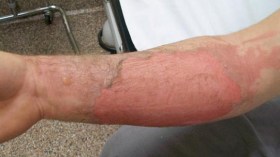 المؤسسات الاستشفائية بتقرت تستقبل المئات من حالات الحروق