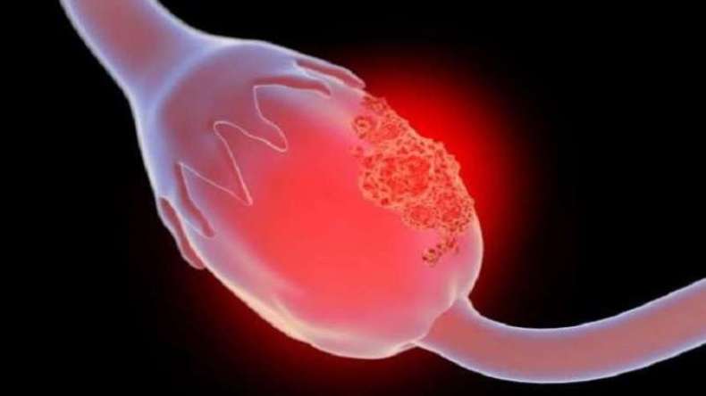 أعراض خطيرة تنذرك بسرطان المبيض.. ماهي؟