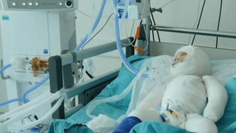 طفلة سورية نزحت 7 مرات ثم احترقت في مخيم!