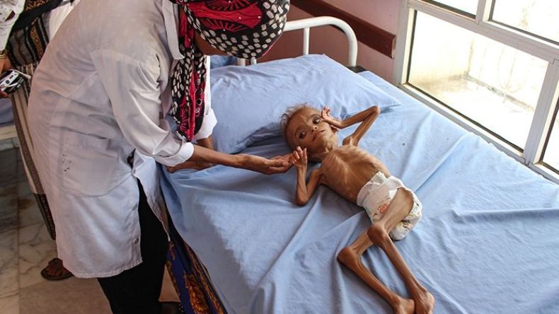 نخسر “الحرب ضد المجاعة” في اليمن