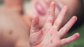 اكتشاف 8 حالات “بوحمرون” بباتنة