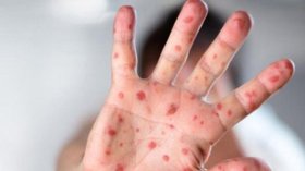 تسجيل ثاني حالة وفاة بداء البوحمرون بششار في خنشلة