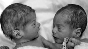 امرأة برحمين تلد توأما مختلفا!