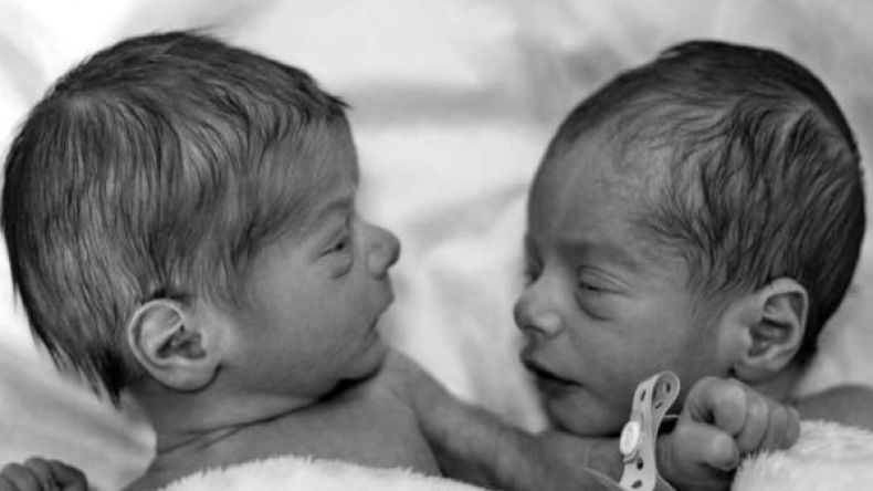 امرأة برحمين تلد توأما مختلفا!