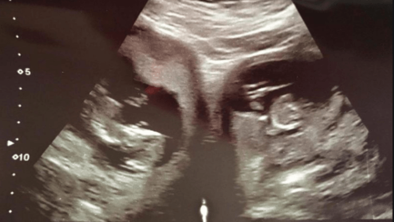 امرأة تلد 3 توائم من رحمين منفصلين!