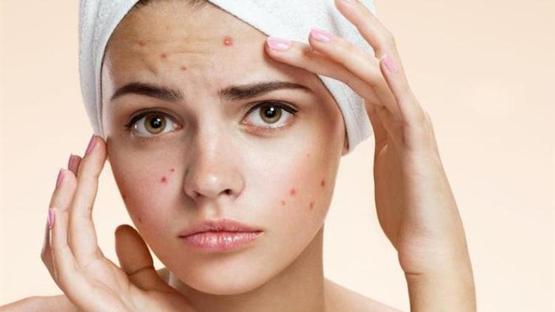 هذه الأسباب غير المتوقعة لظهور حب الشباب؟