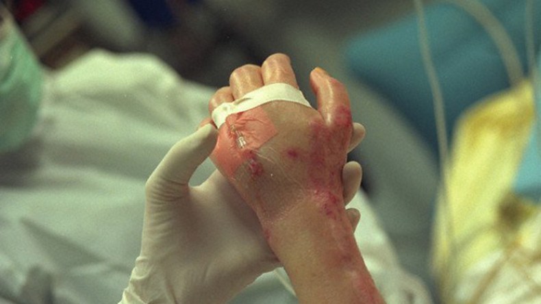 إصابة 10 أطفال بحروق بسبب المفرقعات في قسنطينة