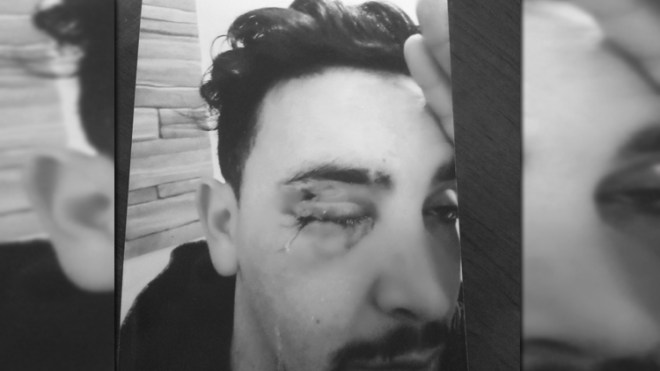 جزائري يفقد عينه في المسيرة ويطالب بتكفل صحي مستعجل