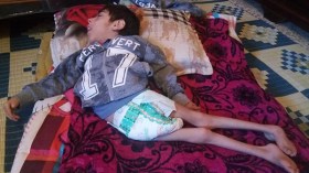 فارس.. طفل تجاوزت سنه حجم جسمه بسبب مرض غريب أصابه!