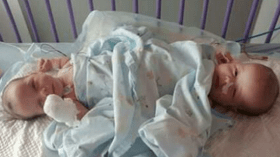 نجاح عملية جراحية لفصل توأم ملتصق من ميلة