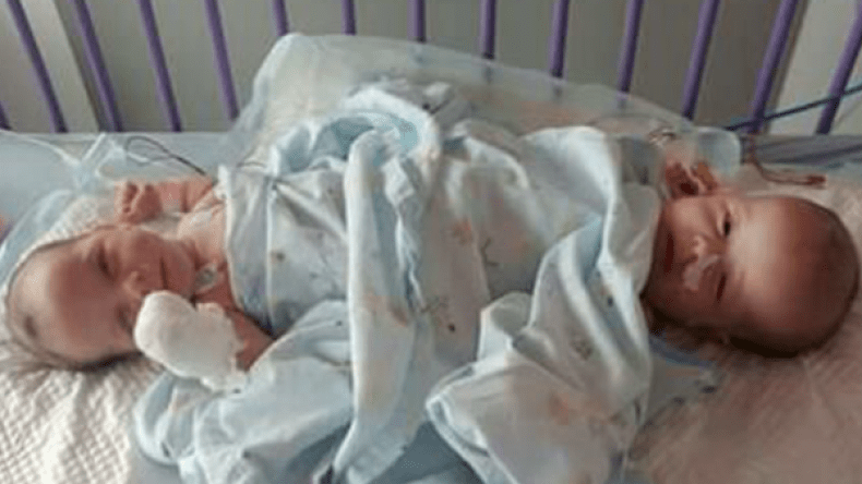 نجاح عملية جراحية لفصل توأم ملتصق من ميلة