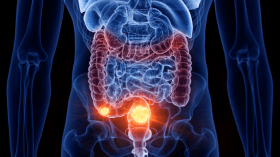 طبيب ألماني يحذّر من 3 أطعمة تتسبب بسرطان الأمعاء