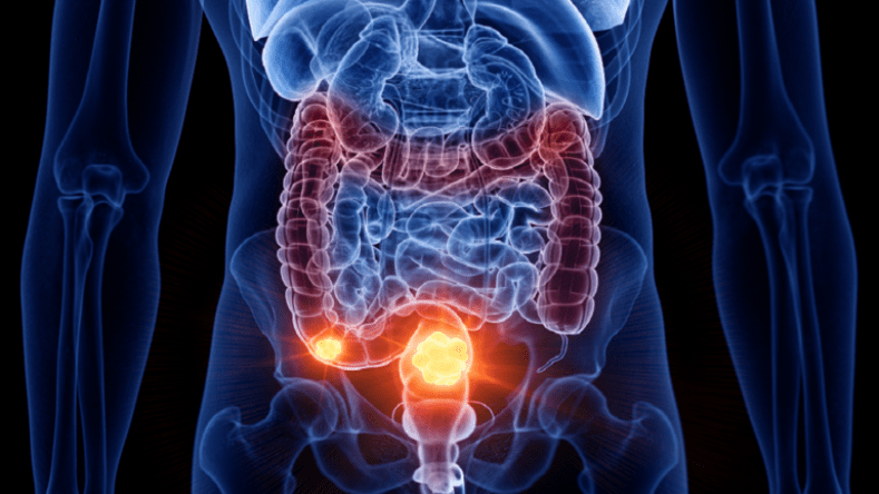طبيب ألماني يحذّر من 3 أطعمة تتسبب بسرطان الأمعاء