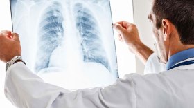 سرطان الرئة قتل نحو 5 آلاف جزائري في 2020