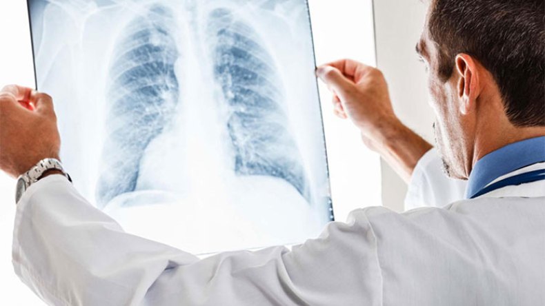 سرطان الرئة قتل نحو 5 آلاف جزائري في 2020