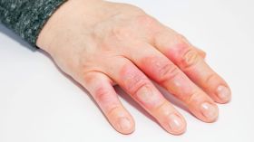 هكذا يجب التعامل مع شخص مصاب بحروق مباشرة بعد الحادثة