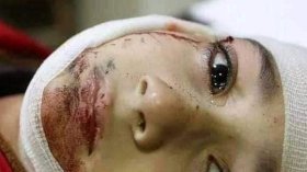 ما حقيقة الصورة المتداولة لطفلة أصيبت في حرب اليمن؟