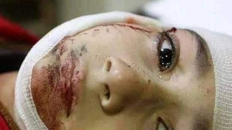 ما حقيقة الصورة المتداولة لطفلة أصيبت في حرب اليمن؟