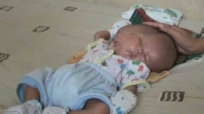 صورة لرضيع بوجهين تحدث جدلا واسعا عبر مواقع التواصل.. وهذه حقيقتها!