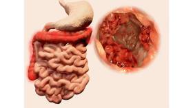 3 علامات قد تنقذك من الموت.. طبيبة بريطانية تكشف الأعراض الدقيقة لسرطان الأمعاء