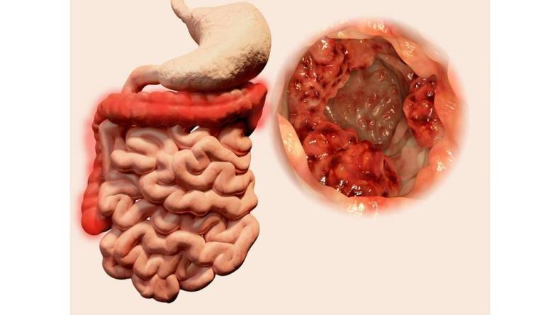 3 علامات قد تنقذك من الموت.. طبيبة بريطانية تكشف الأعراض الدقيقة لسرطان الأمعاء