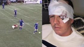 لاعب اسكتلندي يتعرض لنطحة قوية كادت تفقده عينه (فيديو)