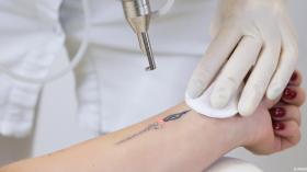 للتخلص النهائي من آثار الوشم غير المرغوب