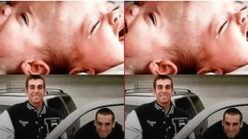 هذه حقيقة الصورة المتداولة لتوأمين ملتصقين قبل وبعد عمليّة فصلهما!