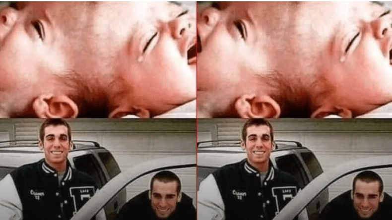 هذه حقيقة الصورة المتداولة لتوأمين ملتصقين قبل وبعد عمليّة فصلهما!