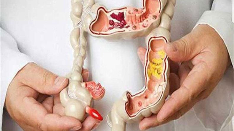 مختصون يحذّرون من تنامي سرطان القولون بسبب الغذاء السيئ!