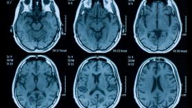 دراسة حديثة: كوفيد 19 قد يتسبب في انكماش الدماغ