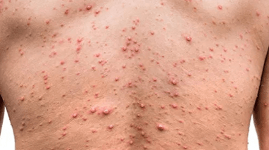 Variole du singe: 16 cas confirmés en France