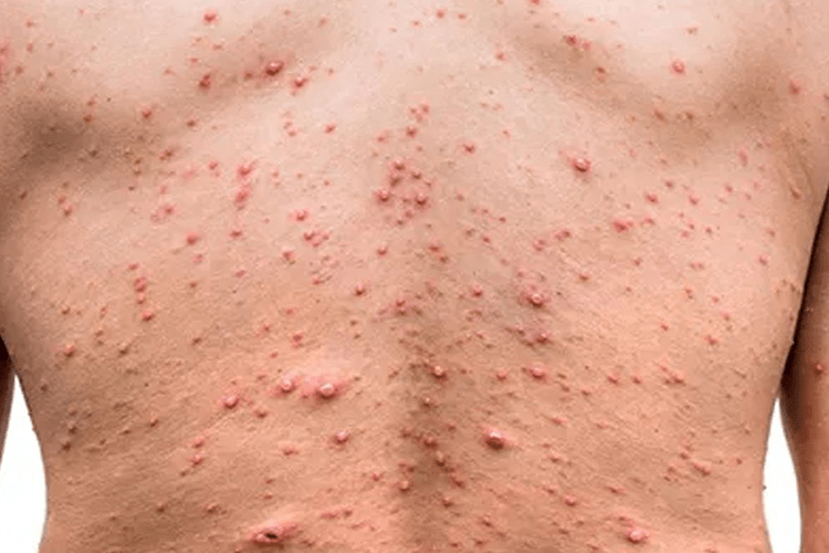 Variole du singe: 16 cas confirmés en France