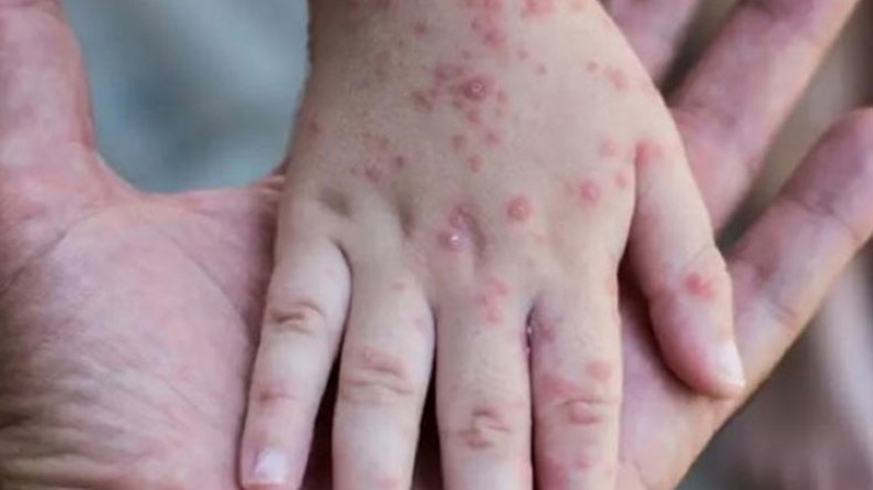 الجزائر مهدّدة بانتشار “جدري القردة”