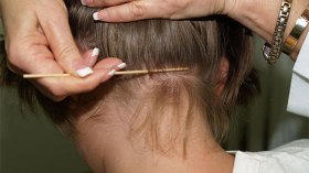 القمل يغزو رؤوس التلاميذ في المدارس