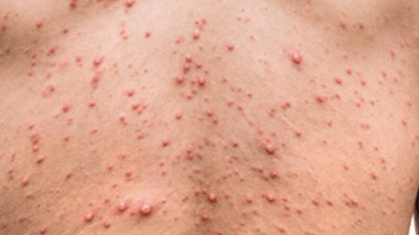 Variole du singe,’l’Algérie n’est pas a l’abri’, selon Dr Akhamouk