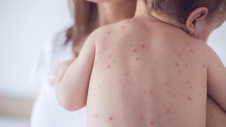 الصحة العالمية تحذر من عودة مرض قديم للأطفال إلى الواجهة بقوة