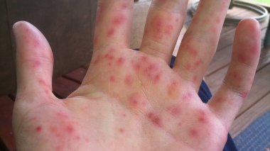 Grippe de la tomate,nouvelle maladie détectée en Inde!