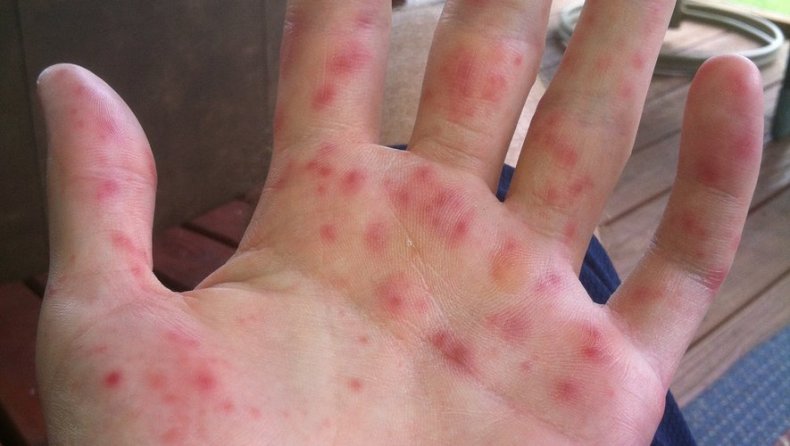 Grippe de la tomate,nouvelle maladie détectée en Inde!