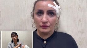 أم تبيع طفلها لإجراء عملية تجميلية لأنفها!