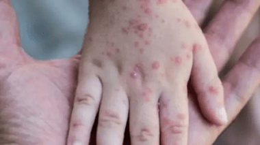 Italie: Un homme testé positif au covid, au VIH et a la variole du singue