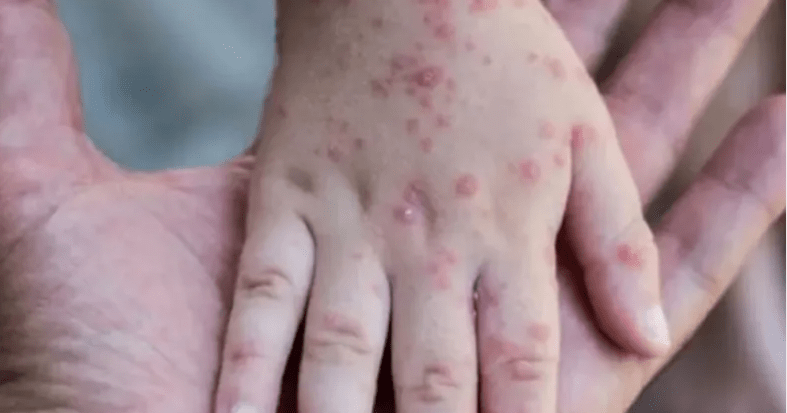 Italie: Un homme testé positif au covid, au VIH et a la variole du singue