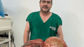 أطباء يستأصلون ورما يزن 45 كلغ من بطن امرأة برازيلية (صور)