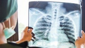 90 بالمائة من إصابات السّرطان سببها التدخين