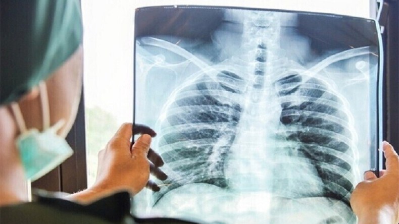 90 بالمائة من إصابات السّرطان سببها التدخين