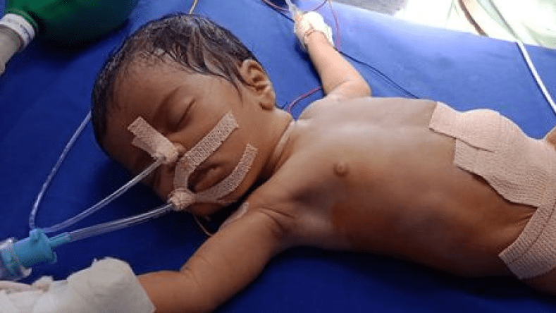 حالتها نادرة جدا.. ولادة طفلة هندية في بطنها 8 أجنة