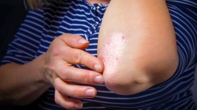 3 أشهر انتظار للحصول على موعد لعلاج الصدفية بالمستشفيات