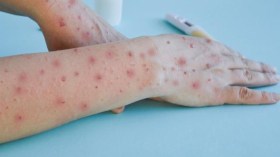 Variole du singe: Appel à se préparer à un éventuel rebond de l’épidémie
