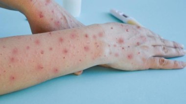 Variole du singe: Appel à se préparer à un éventuel rebond de l’épidémie